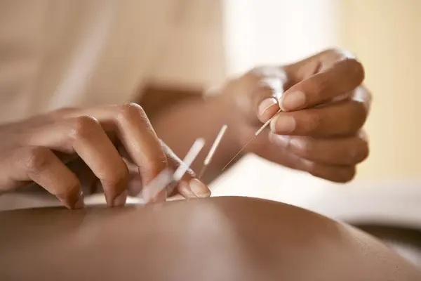 acupuncture benefits