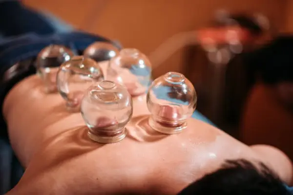 ancient Chinese cupping