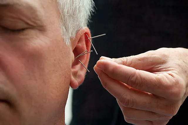 acupunture on ear