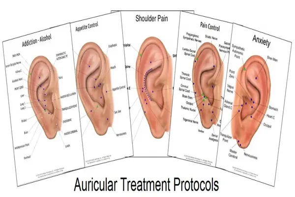 cupuncture on ear