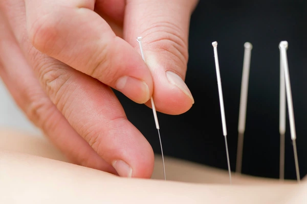 acupuncture therapy