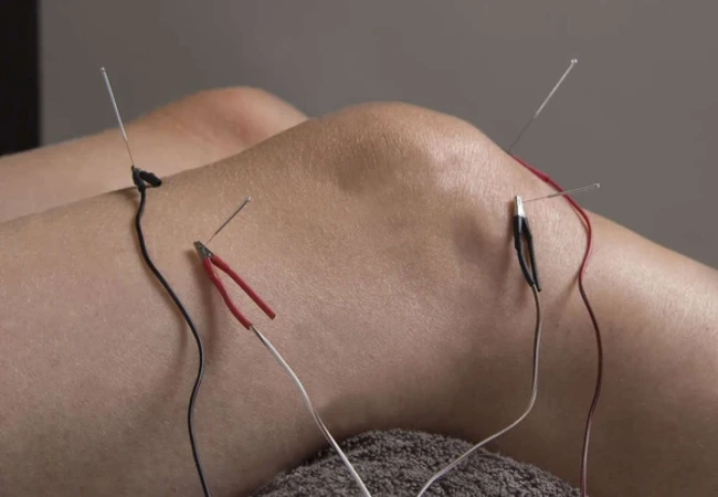 acupuncture needles