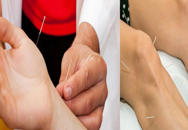 acupuncture needles