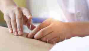 Acupuncture