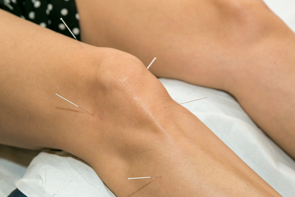 acupuncture needles