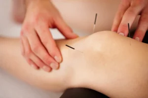 acupunture needles