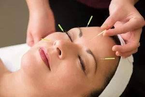 acupunture treatment