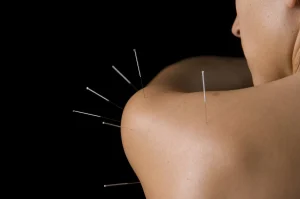 acupuncture therapy on neck