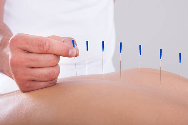 needle therapy