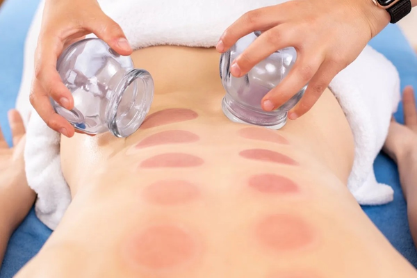 cupping therapy for lower back pain