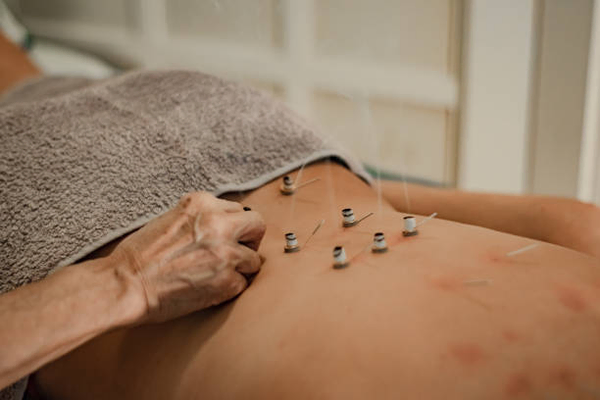 Moxibustion 